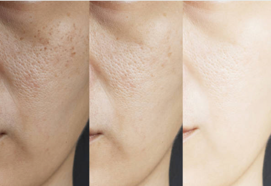 Melasma: What It Is, Who It Affects, and How Trilipiderm Helps Manage It Naturally