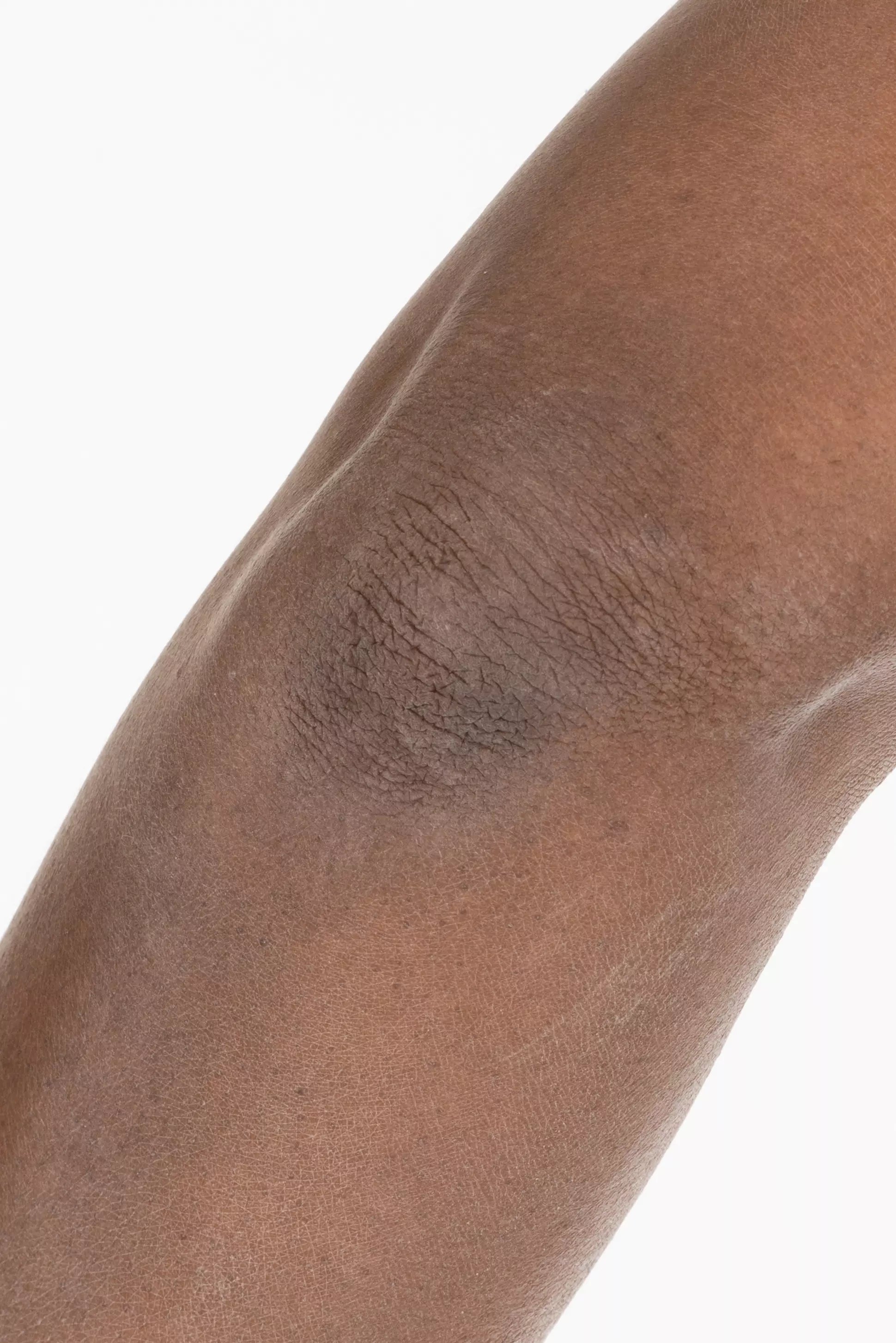 BEFORE USING TRILIPIDERM
