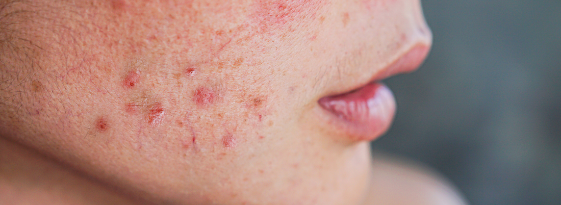 Inflammation: The Frenemy of Your Skin