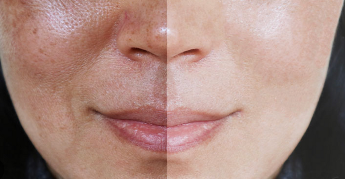 Woman with hyperpigmentation before and after Tranexamic Acid
