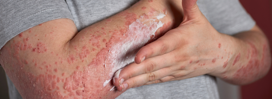 Healing Hydration: Nourishing Your Skin for Psoriasis Awareness Month