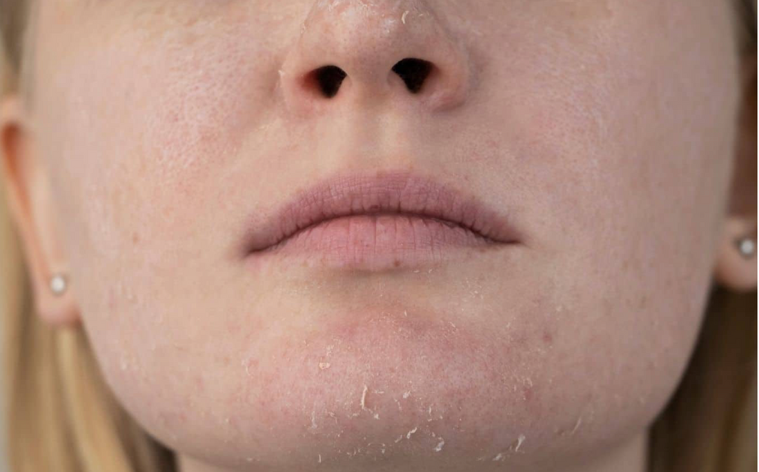 Close-up of a person’s lower face with dry, flaky skin showing a damaged facial moisture barrier.