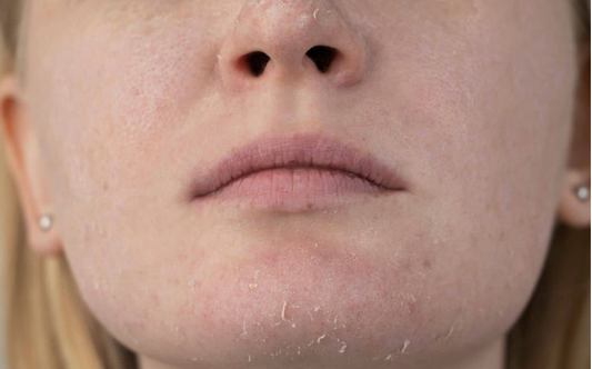 Close-up of a person’s lower face with dry, flaky skin showing a damaged facial moisture barrier.