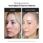 Before-and-after comparison of a woman's face showing acne improvement after 12 weeks, with text reading 'Clinically proven to boost glow & improve radiance' at the top. Trilipiderm Skincare Triple Vitamin C Brightening Serum before and after image showing brightening serum results for dull skin, dark spots, uneven skin tone, radiant glow, smoother texture, antioxidant protection, and glass skin luminosity.