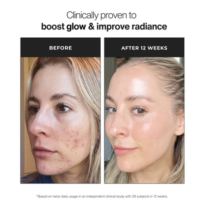 Before-and-after comparison of a woman's face showing acne improvement after 12 weeks, with text reading 'Clinically proven to boost glow & improve radiance' at the top. Trilipiderm Skincare Triple Vitamin C Brightening Serum before and after image showing brightening serum results for dull skin, dark spots, uneven skin tone, radiant glow, smoother texture, antioxidant protection, and glass skin luminosity.