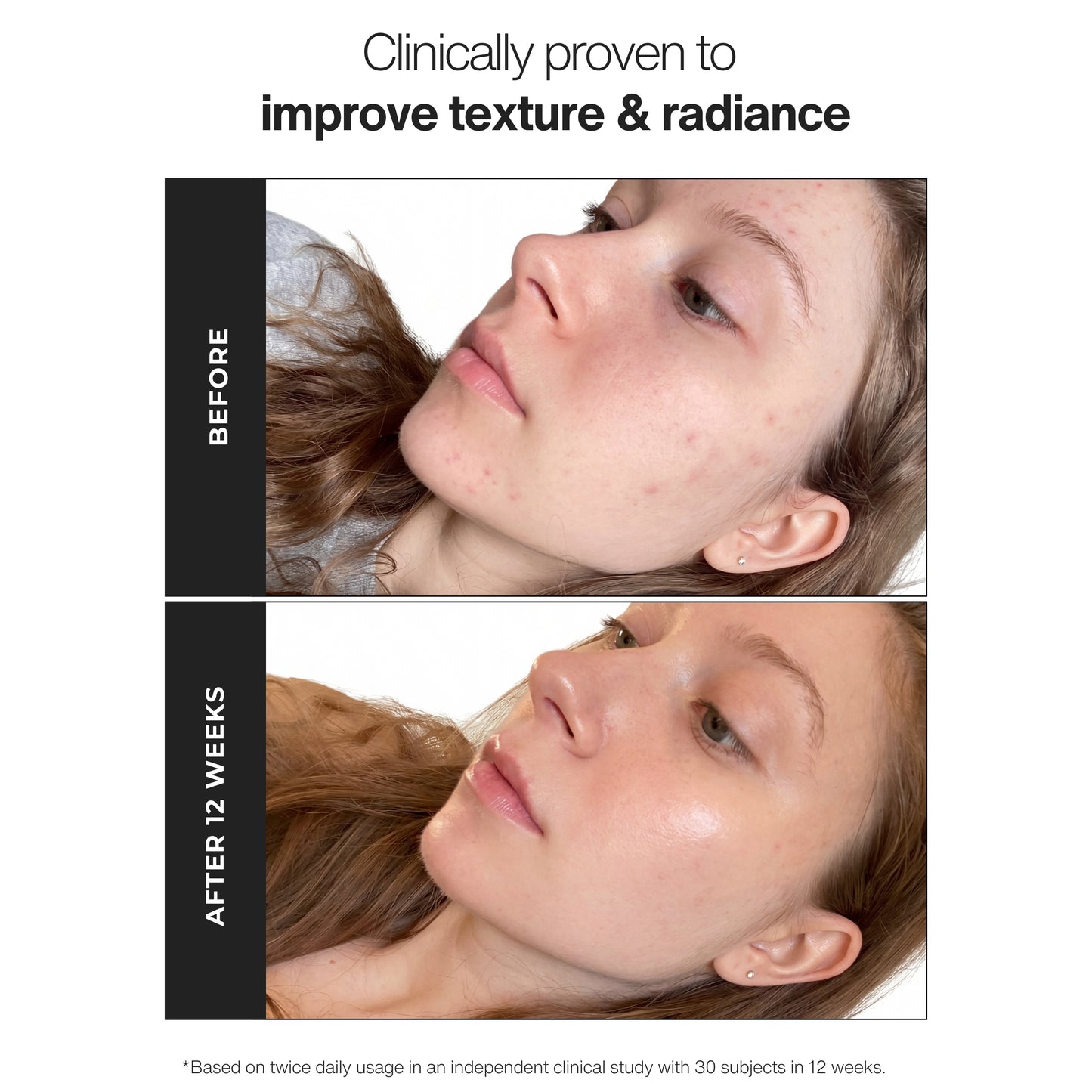 Trilipiderm Skincare Triple Vitamin C Brightening Serum before and after skincare results showing smoother-looking texture, improved radiance, more even-looking skin tone, healthy glow, glass skin finish, and visible brightening benefits.